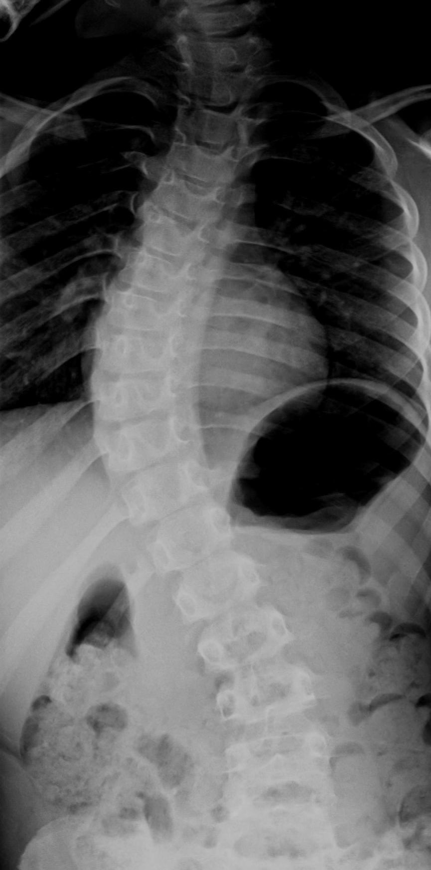 Spine X-ray Analysis